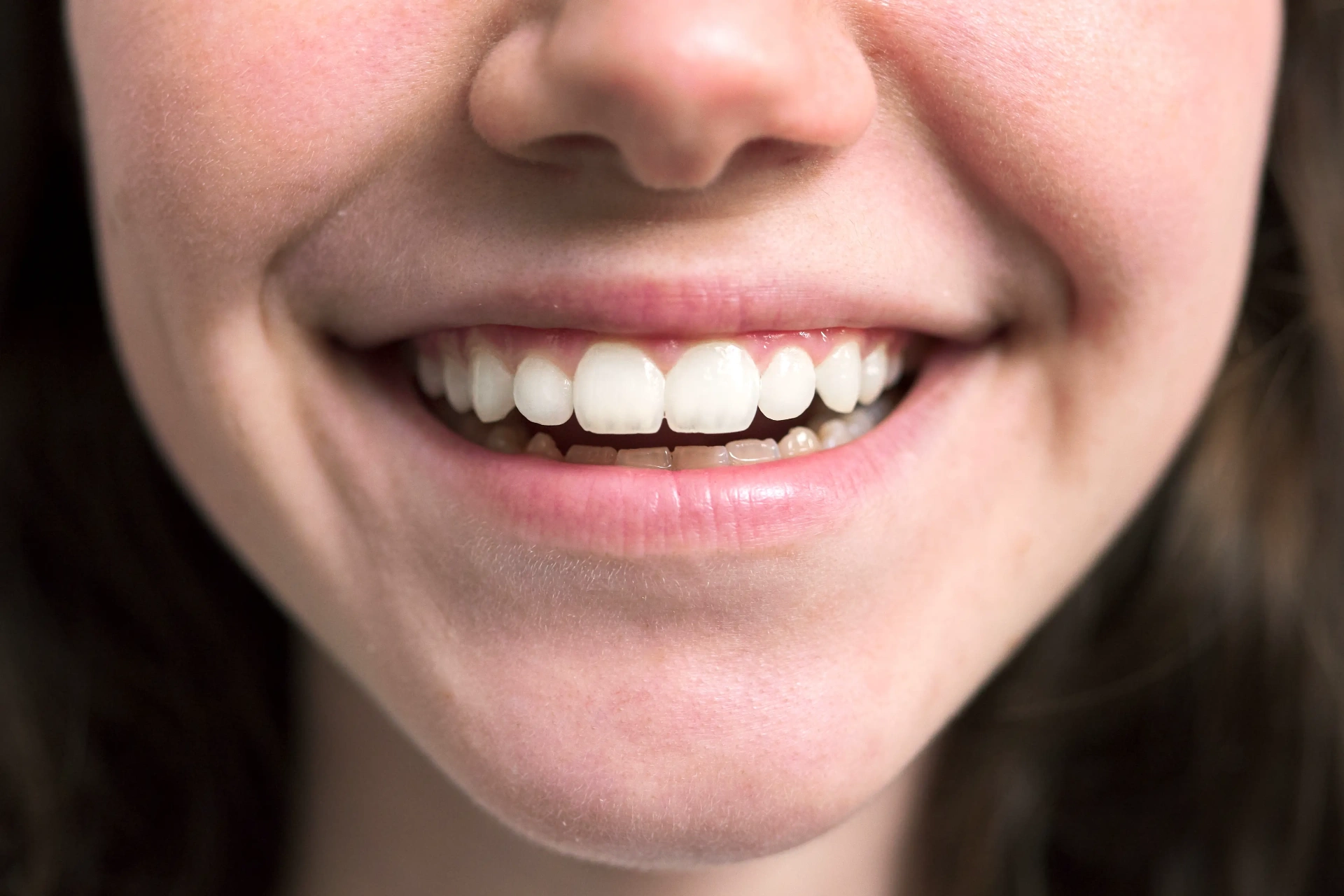 After Laser Dentistry Mississauga - Gum reshaping with laser technology