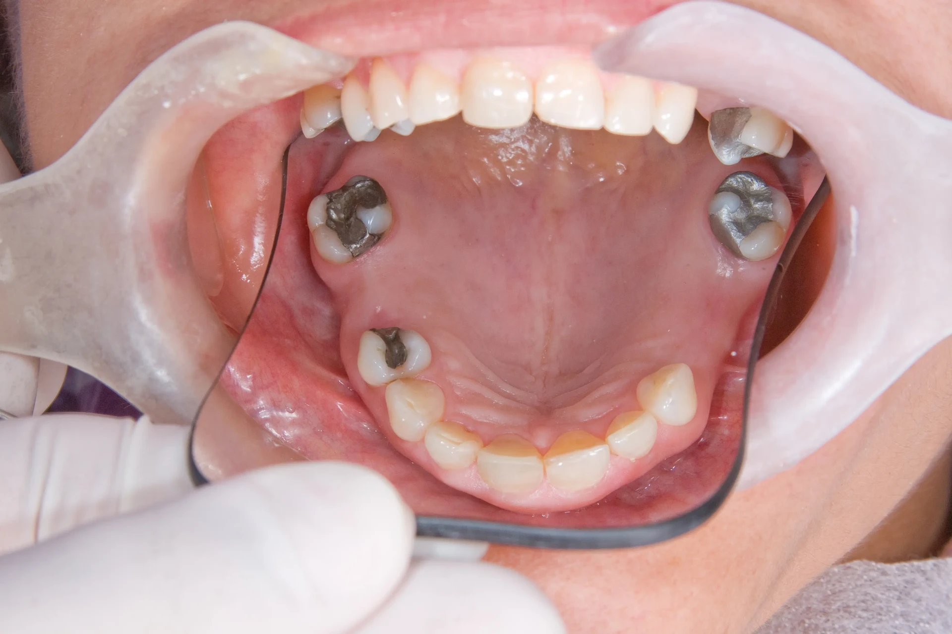 Before Dental Bridges Mississauga - 3-unit bridge restoration