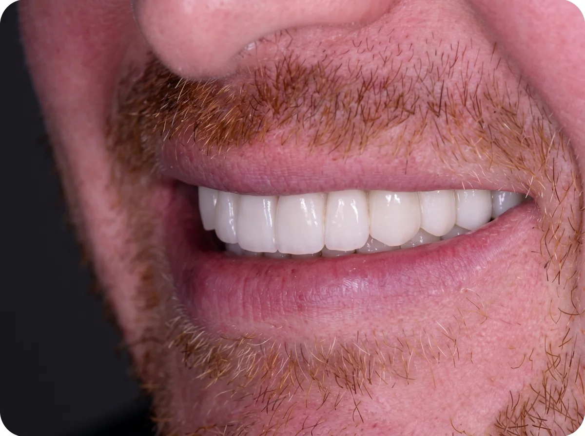 After Dental Implants Mississauga - Single tooth implant restoration