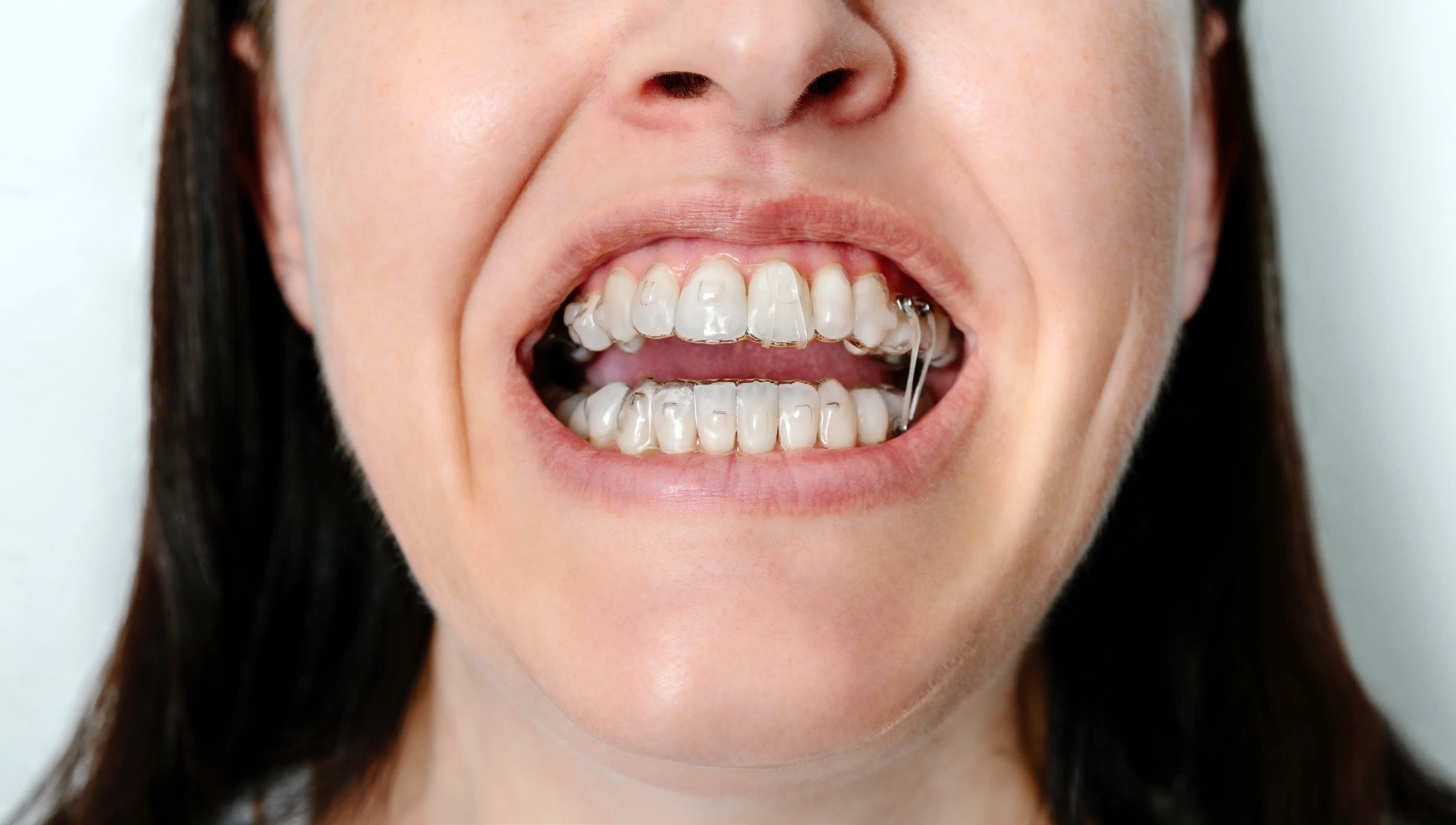 Before Orthodontics Mississauga - Adult orthodontics with clear aligners