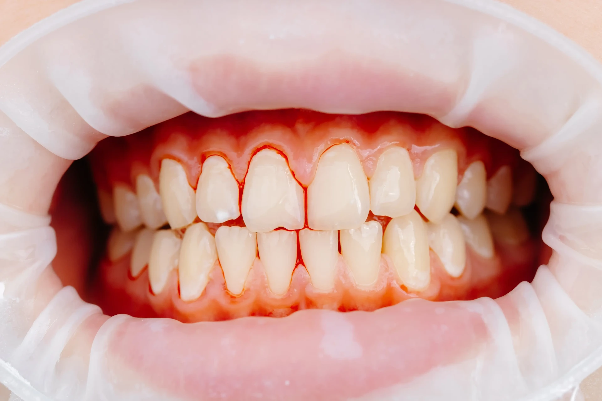 Before Periodontics / Gum Care Mississauga - Gum disease treatment results