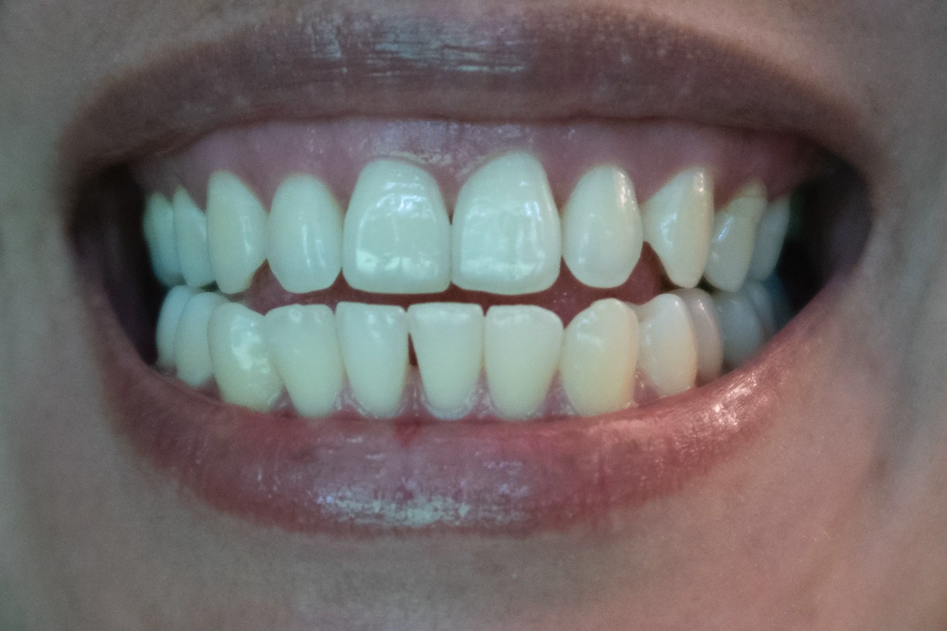 After Restorative Dental Care Mississauga - Full mouth rehabilitation