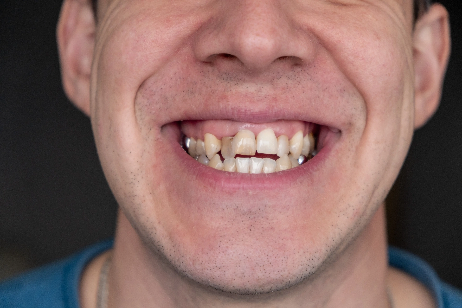 Before Restorative Dental Care Mississauga - Full mouth rehabilitation
