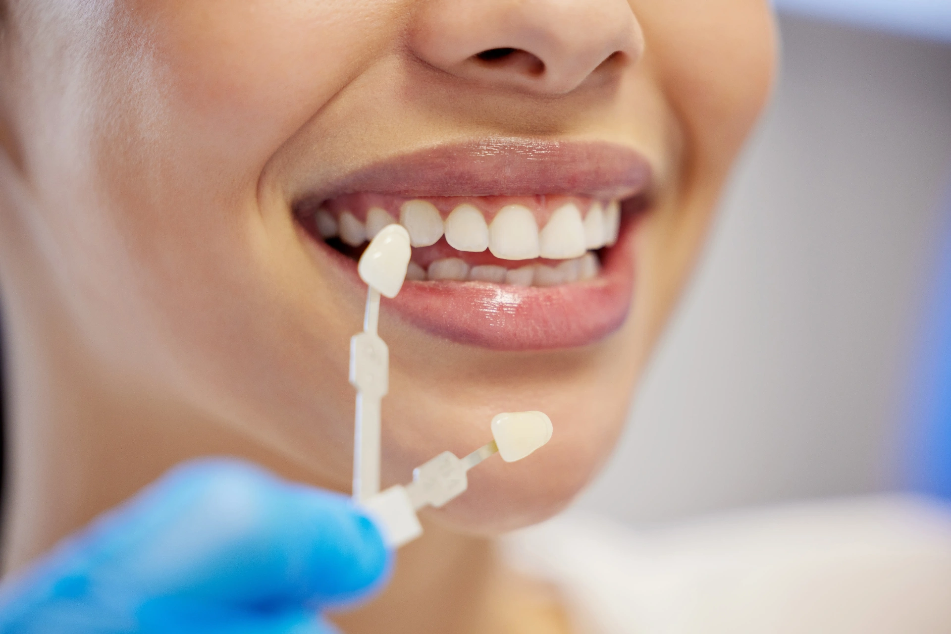 Dental Veneers at Fieldgate Dentistry
