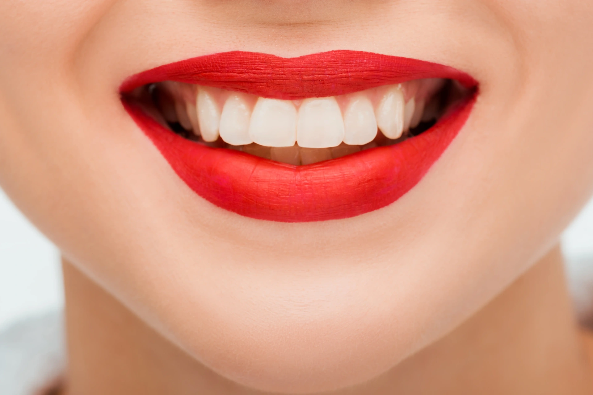 After Cosmetic Dentistry Mississauga - Teeth whitening transformation